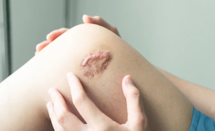 Effective Keloid Treatment: How Huadiefei Scar Removal Liquid Works Screenshot 7 3